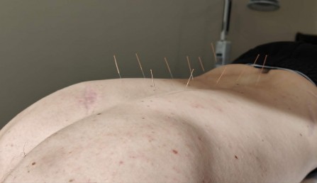 Accupuncture Rory back May 2026