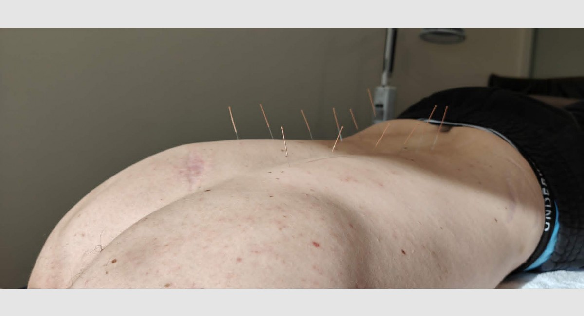 Accupuncture Rory back May 2026