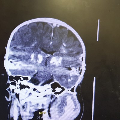 Rory CT scan showing tumor 1 crop