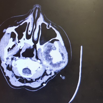 Rory CT scan showing tumor 2 crop