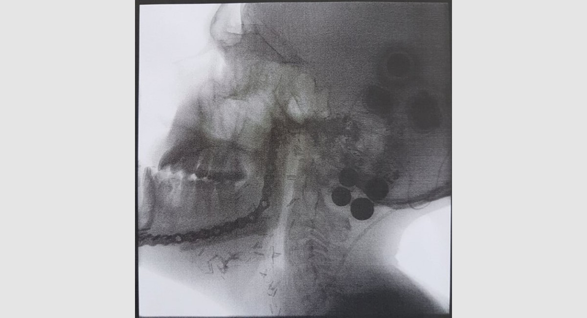 Xray Rory Gardiner LHS face II